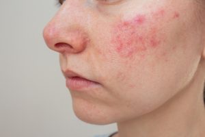 Rosacea roodheid