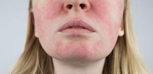 Rosacea roodheid